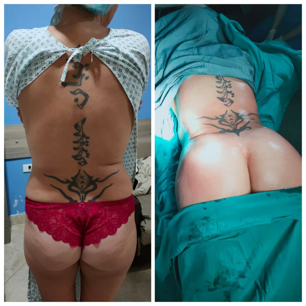 نحت الظهر وحقن دهون المؤخرة